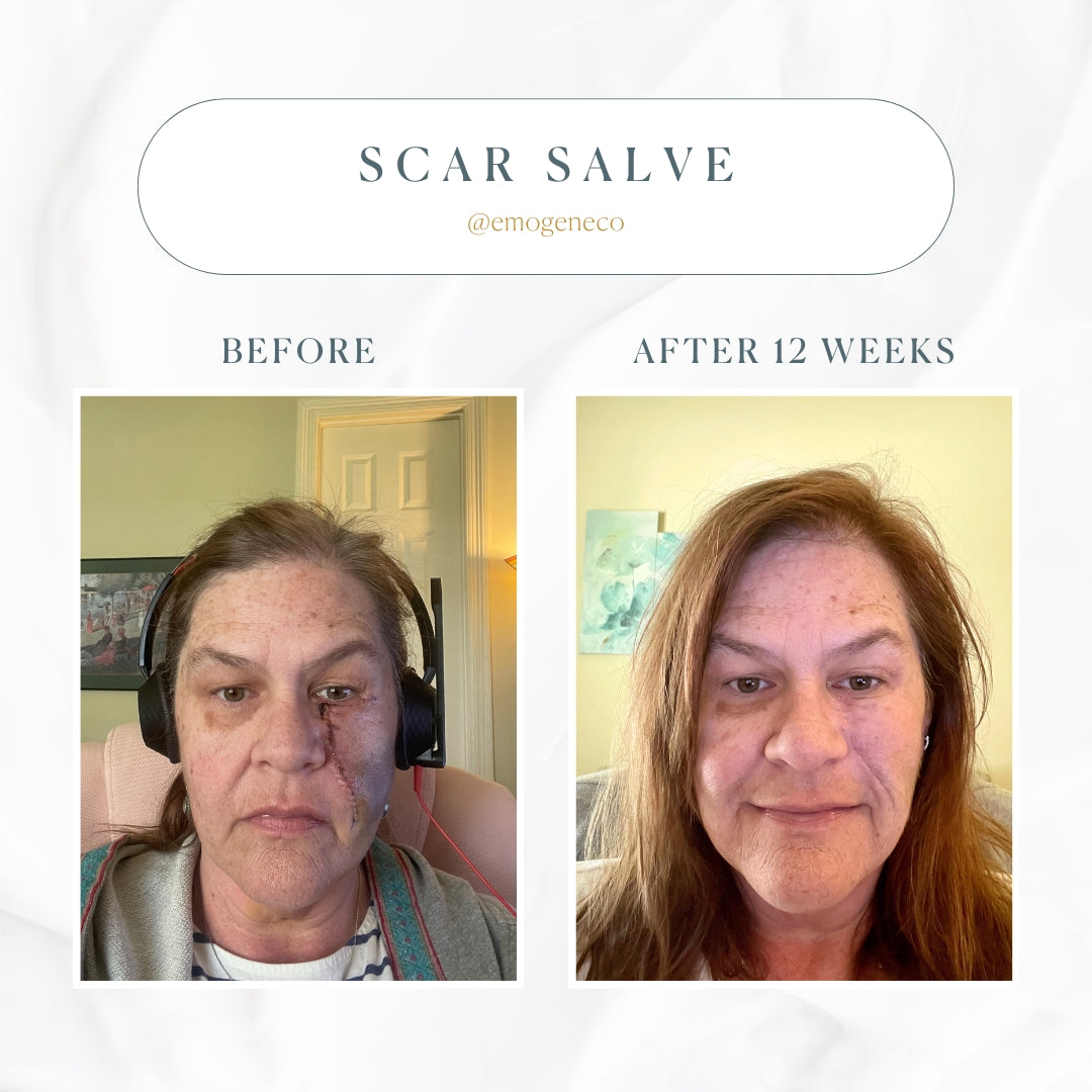 Emogene Signature Scar Salve