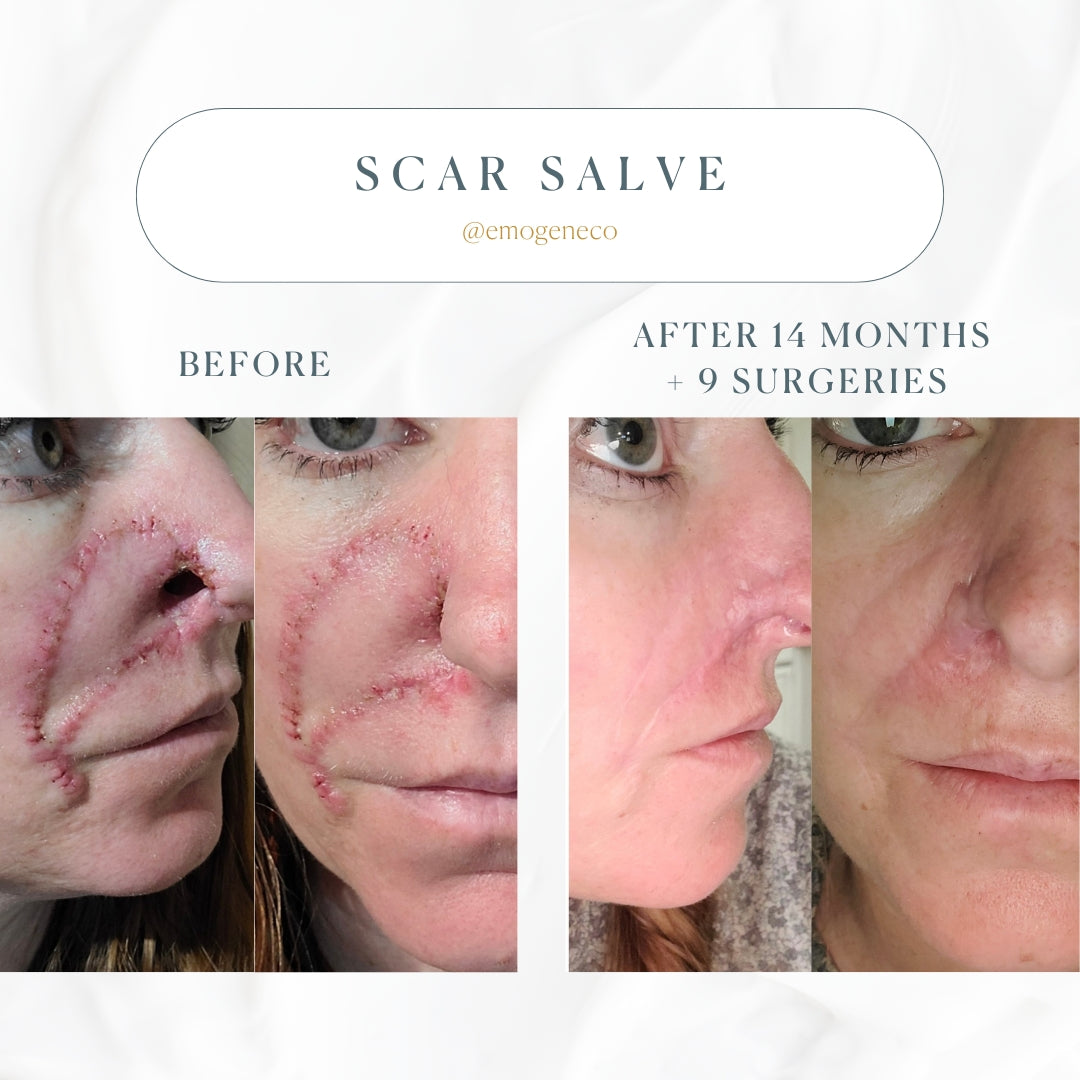 Emogene Signature Scar Salve