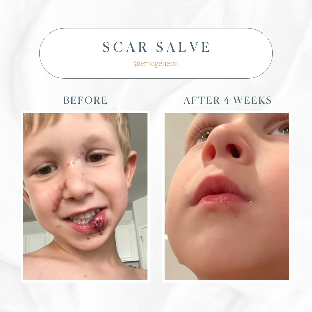 Emogene Signature Scar Salve