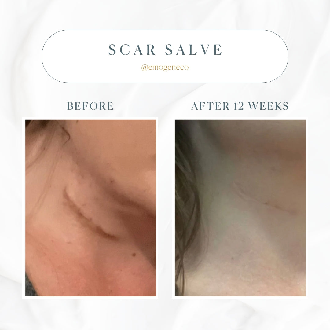 Emogene Signature Scar Salve