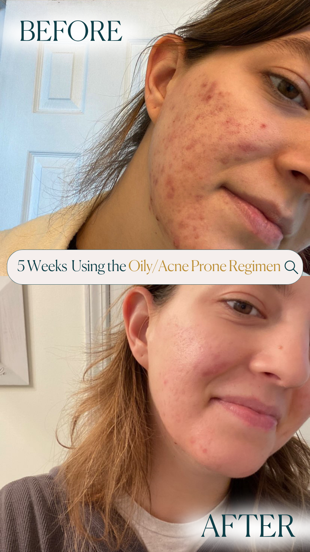 Oily / Acne Prone Skin Advanced Regimen