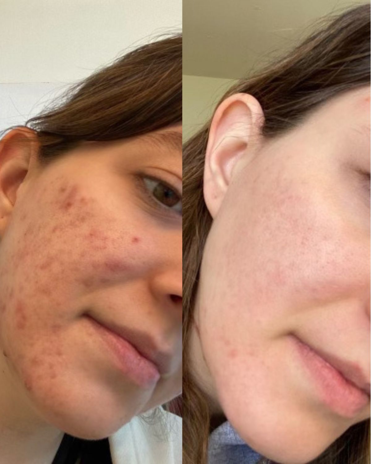 Oily / Acne Prone Skin Basic Regimen